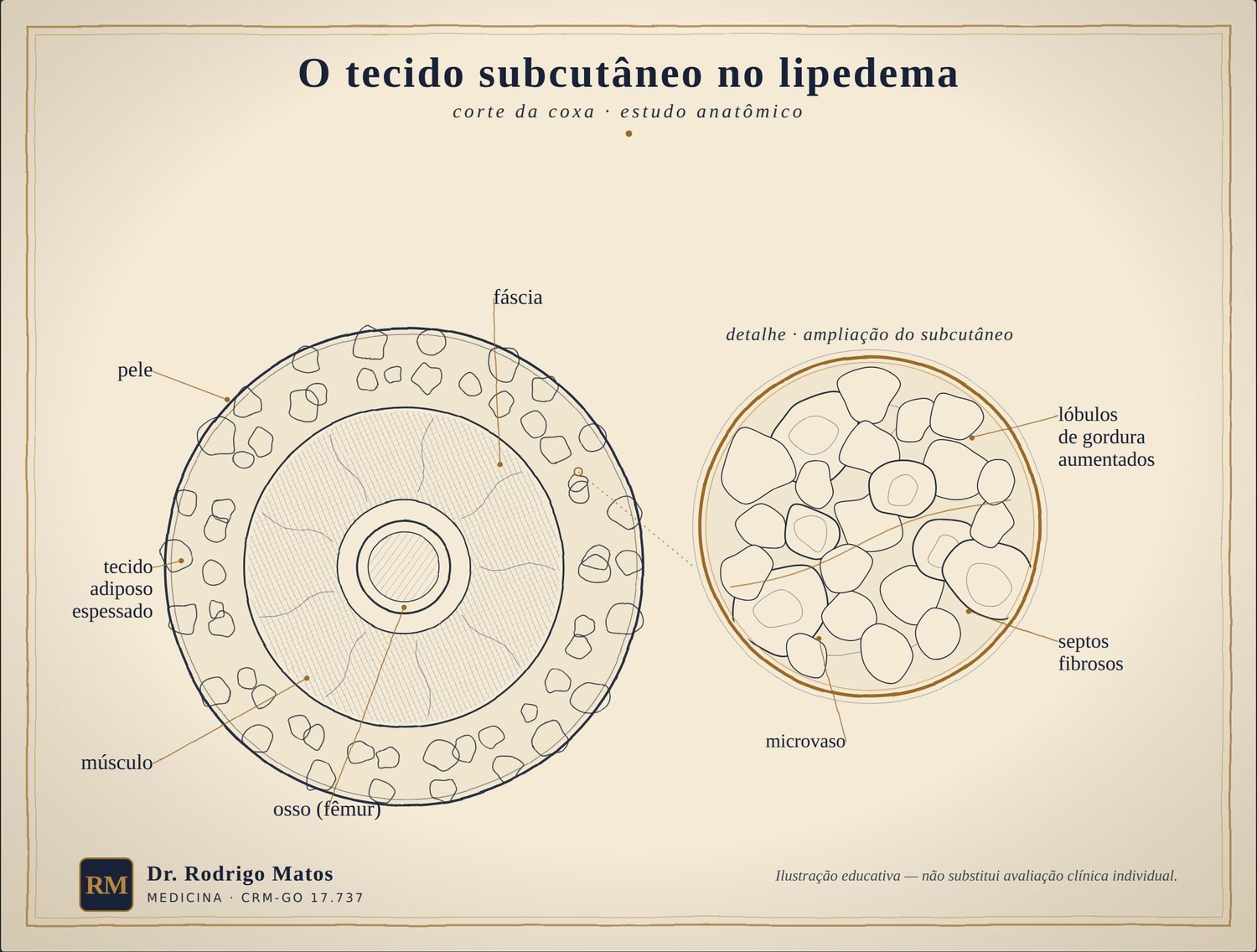 Corte anatômico do tecido subcutâneo no lipedema, mostrando os lóbulos de gordura e os septos fibrosos